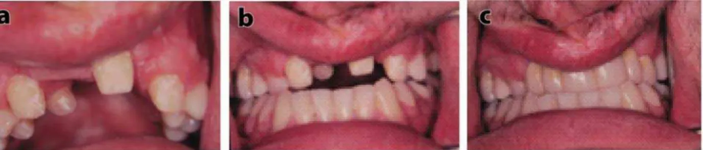 Fig. 1 – a) Dental status in the oral cavity and the maxilla; b) The dental arches in maximal intercuspation; c) Mounted  fixed partial denture