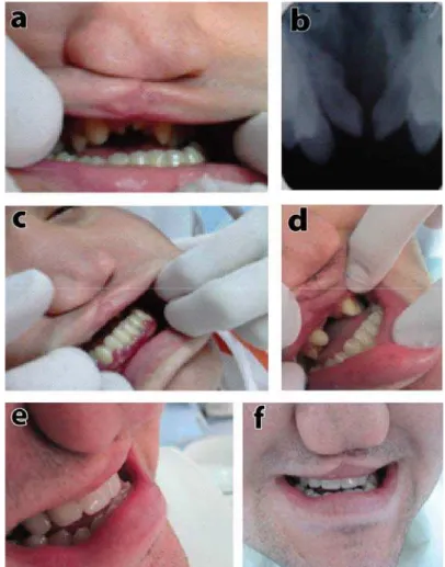 Fig. 3 –a) Micromaxilla; b) X-ray showing the malpositioned teeth; c) Gingival inflammation; d) Abutment teeth  after preparation; e) Metal-ceramic fixed partial denture seated in the patient mouth; f) Appearance after 