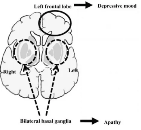 Figura  1.  Diagrama  esquemático  das  correlações  entre  a  localização  da  lesão  e  a  depressão  pós-AVC