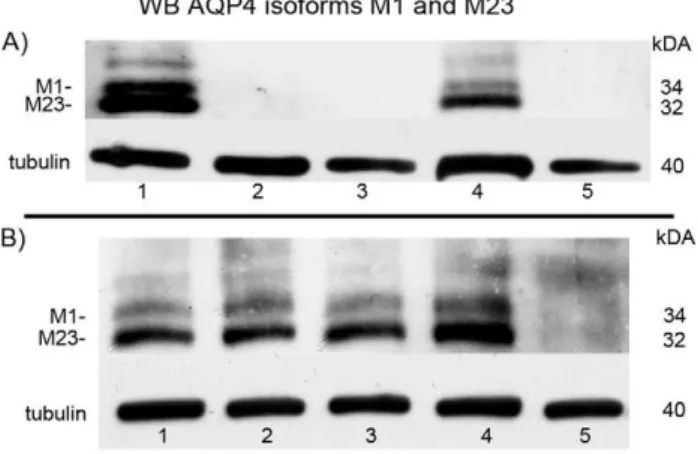 Figure 2. Immunoreactivity against AQP4 (red) and GFAP (green). (A) In human glioblastoma tissue AQP4 (red) shows an intensive staining whereas in primary cell culture of this glioblastoma AQP4 could not be detected (B)