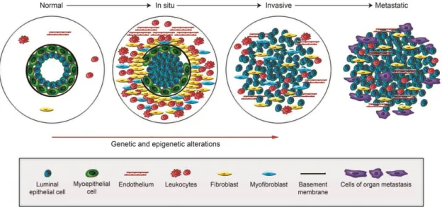 Figure  5.  Schematic  representation  of  the  breast  cancer  carcinogenesis.  Breast  cancer  emerges  as  a  consequence  of  genetic  and  epigenetic  alterations  that  occur  in  myoepithelial  cells,  together  with  a  reduction  in  their  number