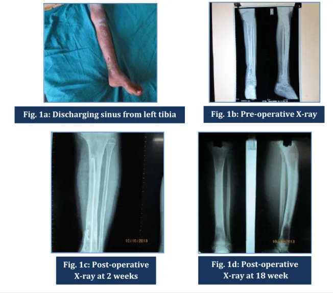 Fig. 1c: Post-operative  X-ray at 2 weeks