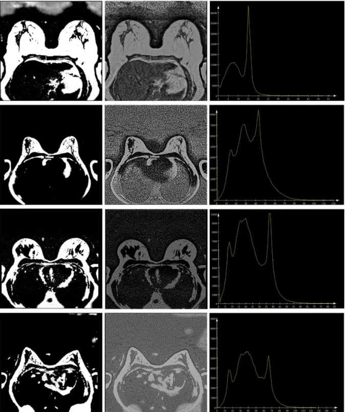 Figure 8. Results for slices, shown in Figure 1. Left column: segmented images; middle column: corrected images; right column: histograms of the corrected images
