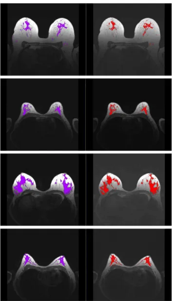 Figure 12. Manual (purple) and automatic (red) parenchyma segmentation results for four datasets.