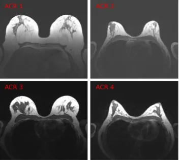 Figure 1. Example slices from 4 different datasets (correspondent to 4 subjects). Each dataset belongs to a different ACR group.