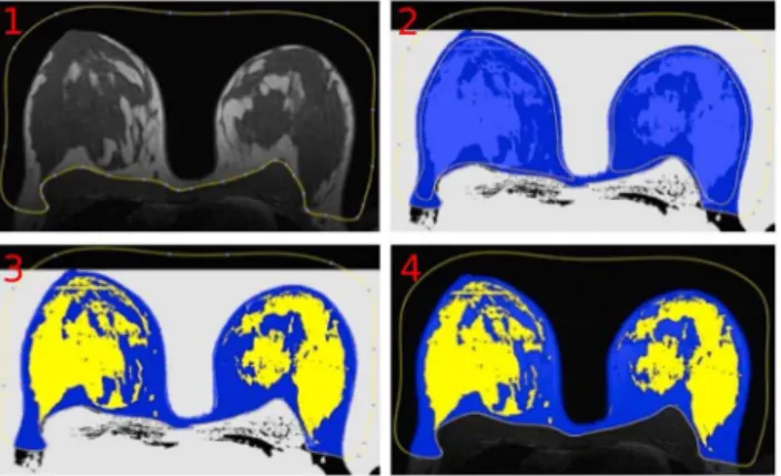 Figure 4. Steps of manual breast segmentation. In each slice, the user first marks the breast boundary and then detects the parenchymal regions.