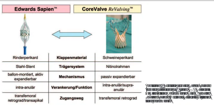 Abbildung 1: Vergleich Edwards Sapien-Prothese (Edwards Lifescience LLC, Irvine, USA, Nachdruck mit freundlicher Genehmigung) und  CoreValve-ReValving-Prothese (Medtronic, Nachdruck mit  freund-licher Genehmigung)