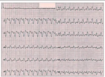 Abbildung 1: EKG bei Aufnahme: Sinustachykardie, f = 135/min, überdrehter Links- Links-typ, ST-Streckenhebung anteroseptal bei Rechtsschenkelblock in aVR.