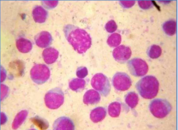 Fig. 3: Bone marrow biopsy-cart wheel  chromatin  of plasma cells  – diffuse 