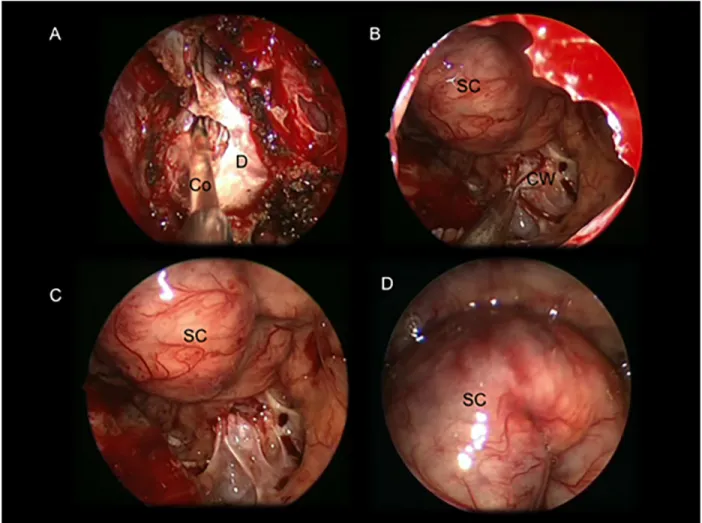 Fig 1. Intraoperative images showing an intra and suprasellar Ratkhe ’ s Cleft Cyst removed via a standard endoscopic endonasalapproach