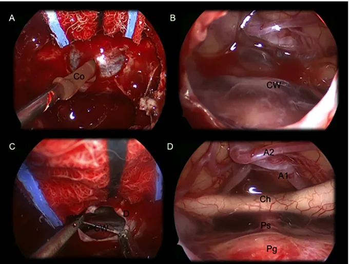 Fig 3. Intraoperative images showing a suprasellar Ratkhe ’ s Cleft Cyst removed via an extended endoscopic endonasalapproach