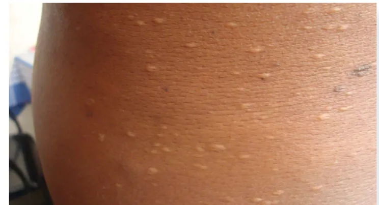 Figure 2. Multiple discrete yellowish sac like protrusions  were seen over both the lanks and posterior aspect of the   trunk