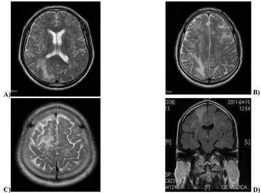 Fig. 2 – A) T2W axial tomogram showing the zones of vasogenic edema of cortical/subcortical localization in the parietal  lobes, more pronounced on the right; B) T2W axial tomogram showing the asymmetric changes frontally on the left,  parietally bilateral