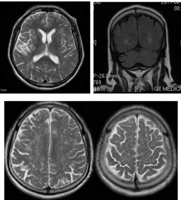 Fig. 3 – Control magnetic resonance imaging (MRI) after two month. T2W axial tomogram and coronal T2W tomogram  showed almost complete regression of the lesion