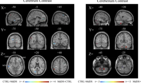 Fig 1. Contrast images of grey matter volume differences between MdDS and controls shown at a threshold of t = 3.0, extent voxels 30 for cerebrum and 10 for cerebellum