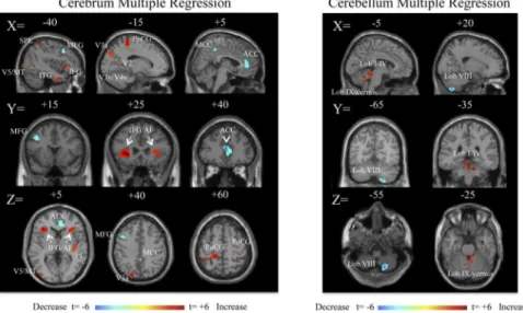 Fig 2. Multiple regression analysis for duration in months, shown at a threshold of t = 3.0, extent voxels 30 for cerebrum and 10 for cerebellum for 27 MdDS participants