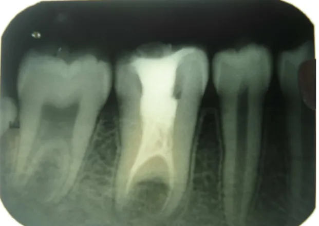 Fig 2:IOPA   showing first and second molars with enlarged 