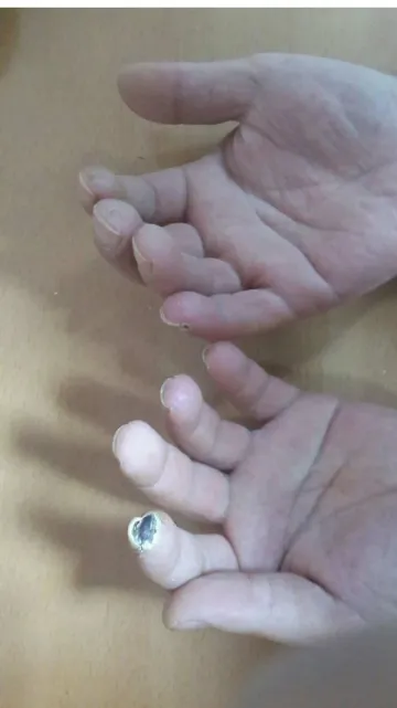 Figure 1. Digital ulcer on the 2nd inger of the let hand