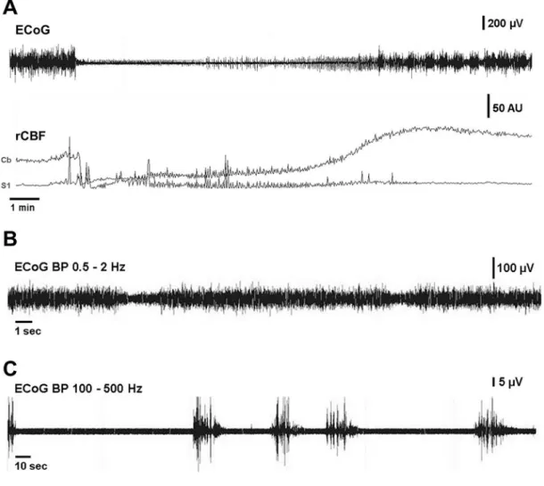 Fig. 5. Exemplary ECoGs during acute SAH. A: Induction of SAH causing immediate severe perfusion impairment corresponds to complete cessation of ECoG signal in some animals lasting several minutes with activity returning in burst suppression patterns
