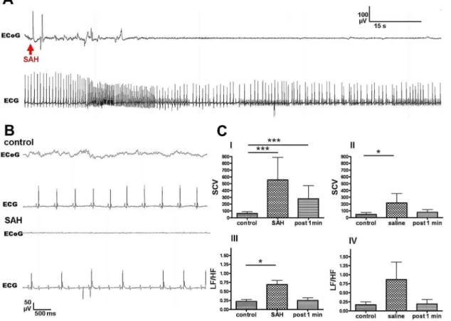 Fig. 6. Cardiac responses to SAH induction. Fig. 6 depicts a sample ECG trace after SAH