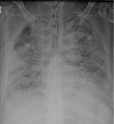 Fig. 3. His normal chest radiograph one year after lung trans- trans-plantation.