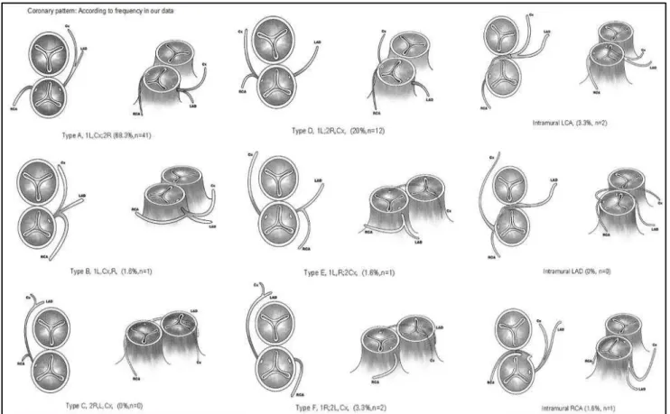 Fig. 1: Coronary artery pattern of all patients group wise  DISCUSSION:  The  transposition  of  great  arteries  is  a 