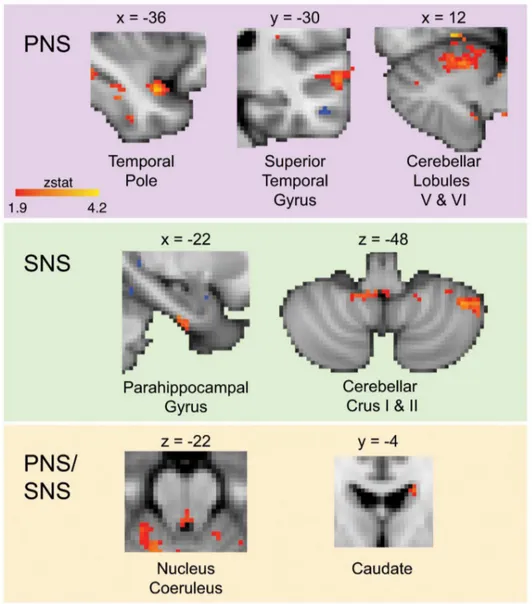 Figure 2. Increased hypothalamic functional connectivity in migraine-healthy controls in parasympathetic and sympathetic nervous system brain structures