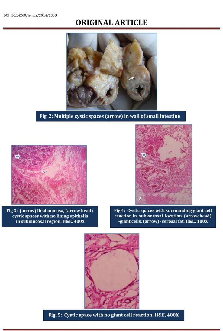Fig. 2: Multiple cystic spaces (arrow) in wall of small intestine 