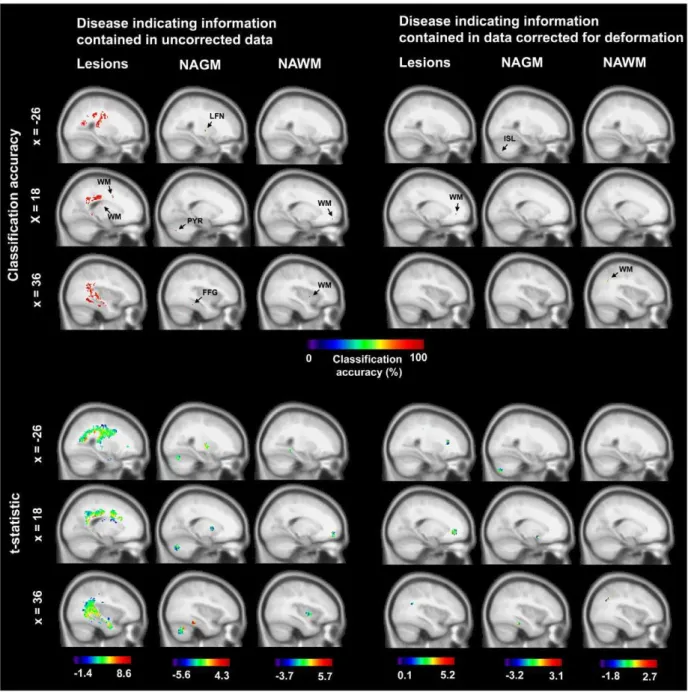 Figure 4. Brain regions with information on the clinical status. Top: Center coordinates of searchlight classifiers with above-chance accuracy in the separation of patients and controls