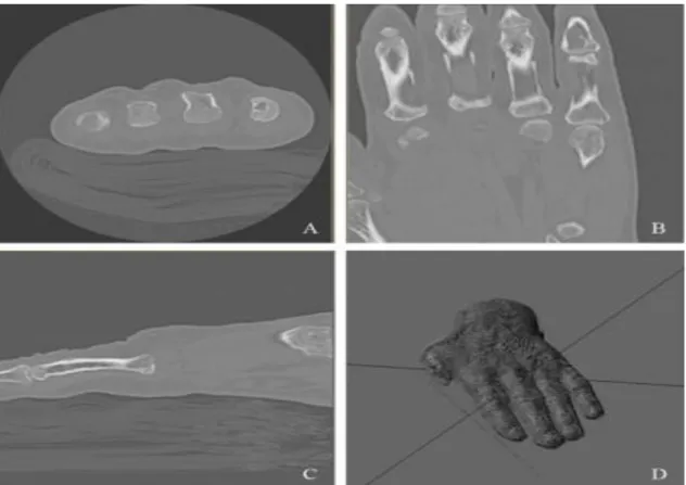 Figure 6 - Multiplanar 2D Images aquired from a CT scan and a 3D Hand Volume. A- Image acquired from the Y-axis; 