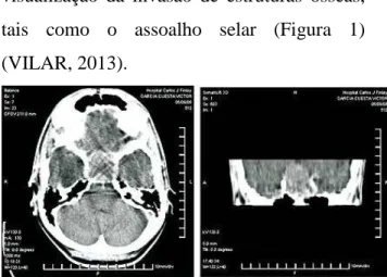 Figura 1. TC de sela túrcica corte axial (à esquerda) e  coronal  (à  direita),  mostrando  macroadenoma  hipofisário  e  diagnóstico  anatomopatológico