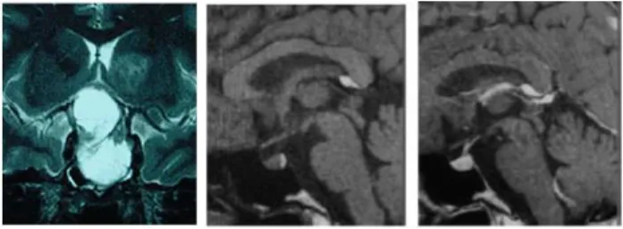 Figura 2. Imagens da região selar por RM. À esquerda  coronal  T2  com  macroadenoma.  Imagens  sagitais  T1,  central e à direita, sem e com contraste da região selar  normal