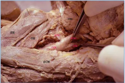 Fig. 1: Showing variation in the origin of the left superior thyroid artery