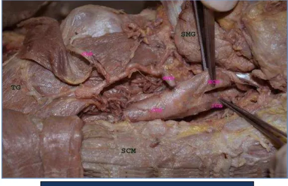 Fig. 2: Showing the course of the left Superior  thyroid artery after removing the infrahyoid muscles