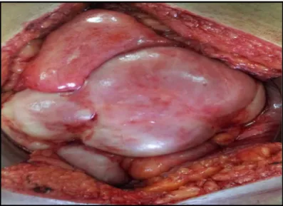 FIG 2: Visceral surface of liver covered with fibrous layer 