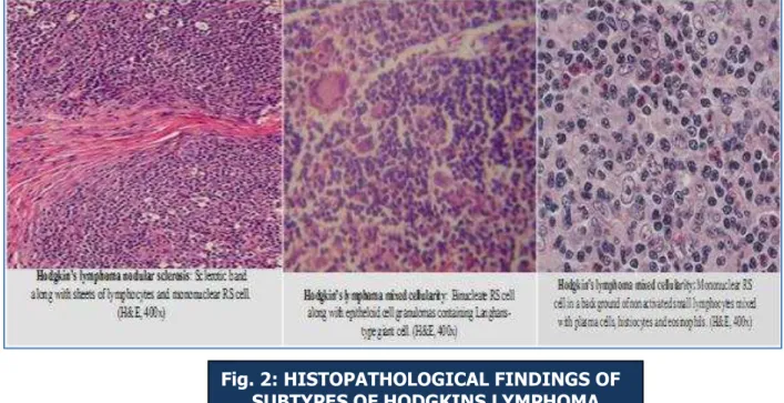 Fig. 2: HISTOPATHOLOGICAL FINDINGS OF   SUBTYPES OF HODGKINS LYMPHOMA