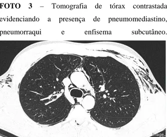 FOTO  3  –  Tomografia  de  tórax  contrastada  evidenciando  a  presença  de  pneumomediastino,  pneumorraqui  e  enfisema  subcutâneo