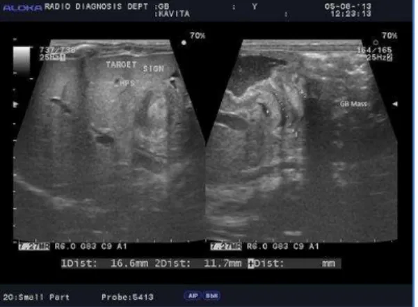 Fig. 2: Image shows Gall Bladder Mass with infiltration of liver