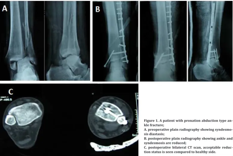 Figure 1. A patient with pronation abduction type an- an-kle fracture; 