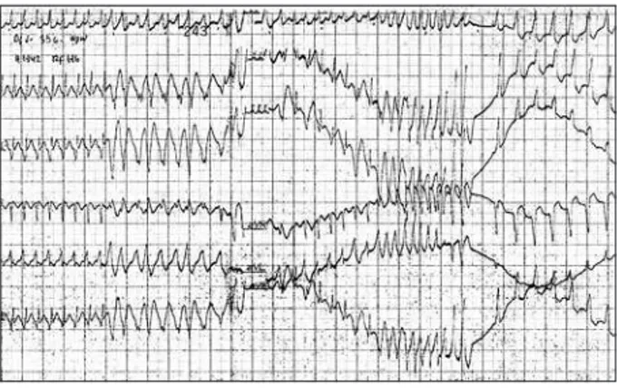 Figure 1. Initiation of atrial fibrillation (AF) resulted from degenerati­