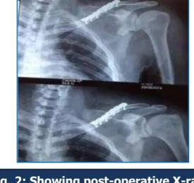 Fig. 2: Showing post-operative X-rays 