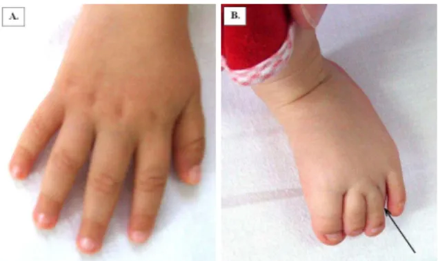 Figure  1.  Abnormalities  of  fingers  with  thumb  implantation  in  the  same  plan  with  the  other  fingers  (1A)  and  abnormal  implantation of the fourth toe (1B) 