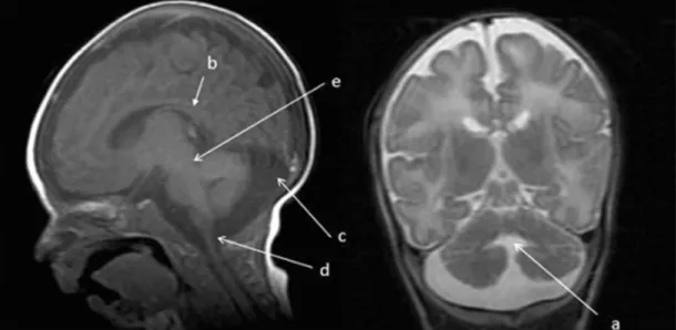 Figura  2  –  imagens  da  ressonância  nuclear  magnética,  evidenciando  hipoplasia  dos  hemisférios  cerebelares (a), hipoplasia do vermis cerebelar (b) e alargamento da cisterna magna (c).
