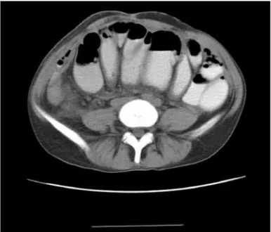 Figure 1: Multiple dilated ileal segments illed with oral contrast  medium are shown in this enhanced axial CT of the abdomen  signifying bowel obstruction