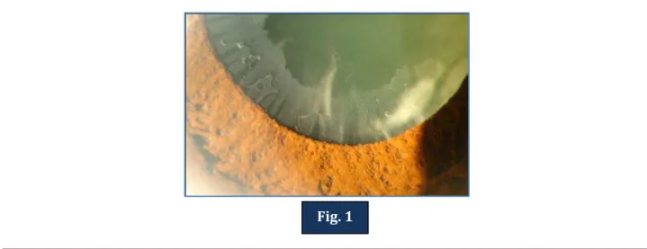 Fig. 1: Image pseudoexfoliative material over the lens surface. 