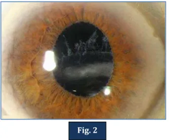 Fig .3: Iris hooks 