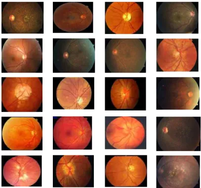 Fig .2. Image used for drusen detection. 