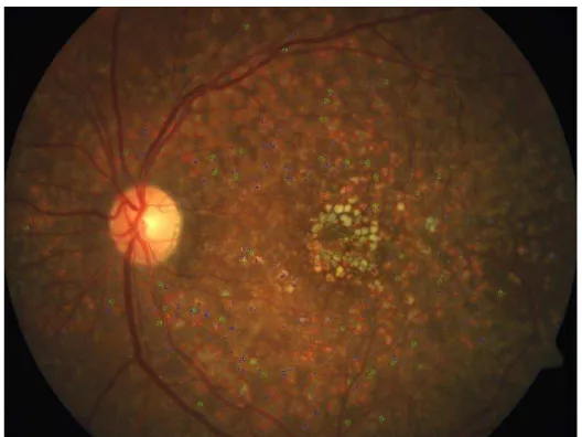 Fig .7. Drusen Detected Image. 