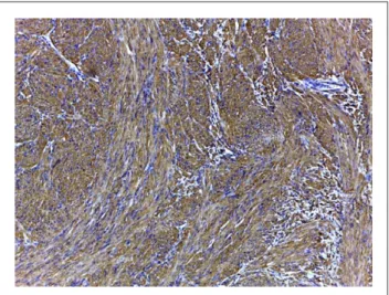 Figure 4  Microscopic findings. (a) Section of the urinary  bladder mass characterised by a proliferation of spindle cells  irregularly arranged in interwoven and concentric bundles