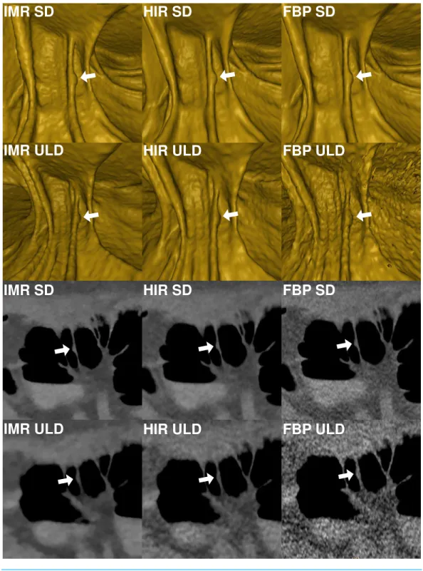 Figure 4 Comparison of image quality of a small (7.9 mm) flat lesion in the ascending colon shown in virtual endoscopic view and thin 0.9 mm sections in a colonic window (900/100 HU) demonstrates markedly reduced image quality in FBP-ULD